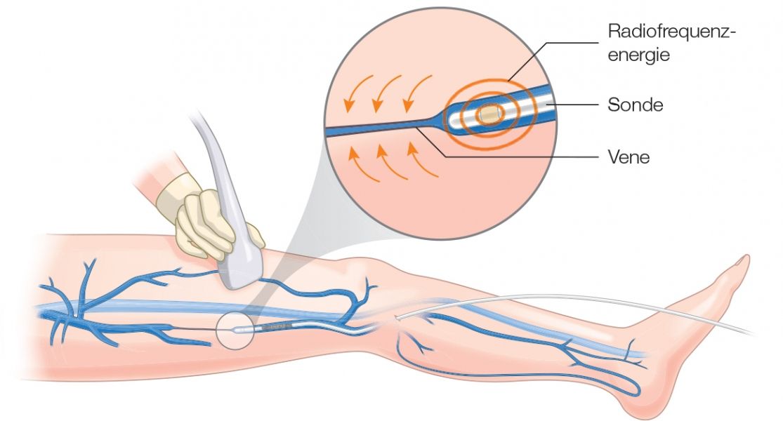 Illustration einer Venentherapie mit dem neuesten Radiofrequenzsystem zur schonenden Behandlung von Venen.